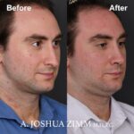 Rhinoplasty - before and after