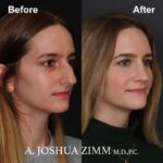 Rhinoplasty - before and after