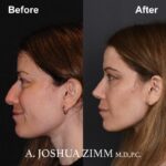 Rhinoplasty - before and after