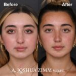 Rhinoplasty - before and after