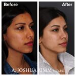 Rhinoplasty - before and after