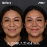 Rhinoplasty - before and after