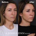 Rhinoplasty - before and after