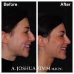 Chin implant - before and after