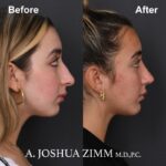 Chin implant - before and after