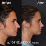 Rhinoplasty - before-and after