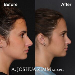 Rhinoplasty - before-and after