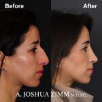 Rhinoplasty - before and after