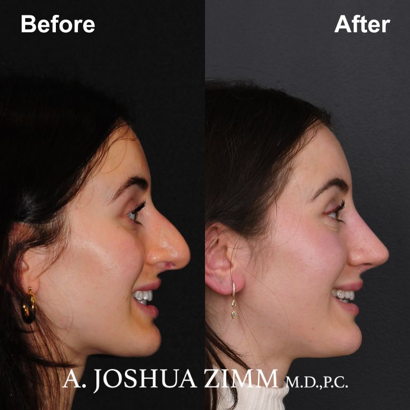 Rhinoplasty - before and after