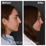 Rhinoplasty - before and after