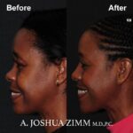 Rhinoplasty - before and after