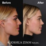 Rhinoplasty - before and after