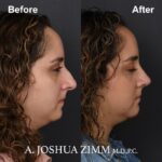 Rhinoplasty - before and after