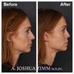 Rhinoplasty - before and after