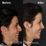 Rhinoplasty - before and after