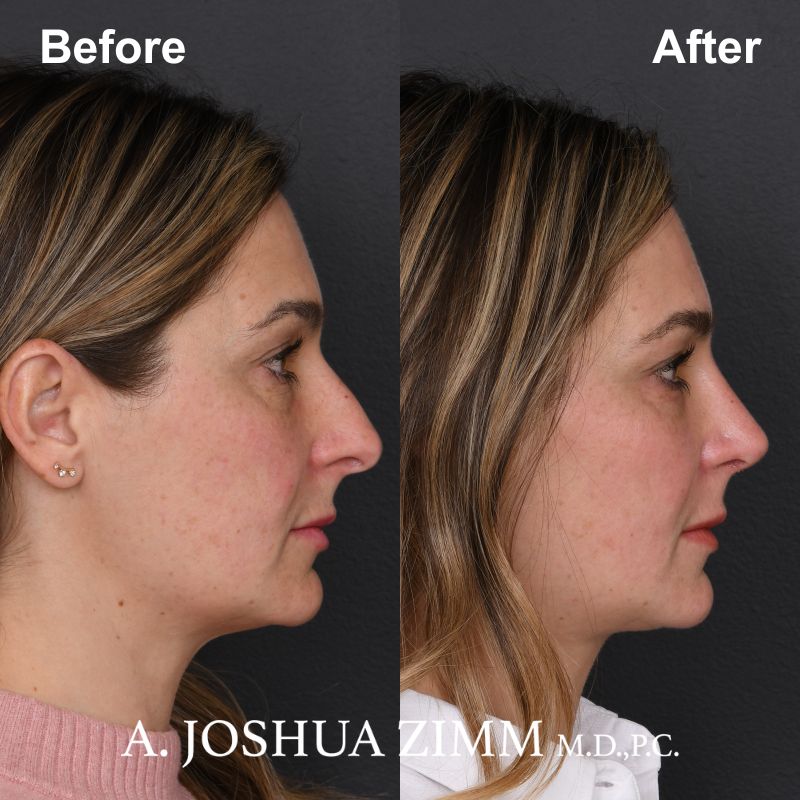 Rhinoplasty - before and after