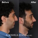 Rhinoplasty - before and after