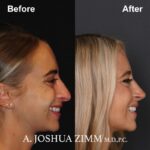 Rhinoplasty - before and after