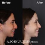 Rhinoplasty - before and after