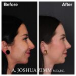 Rhinoplasty - before and after