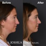 Rhinoplasty - before and after