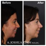 Rhinoplasty - before and after