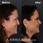 Rhinoplasty - before and after