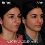 Rhinoplasty - before and after