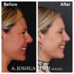 Rhinoplasty - before and after