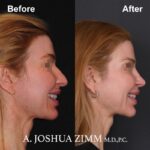 Rhinoplasty - before and after