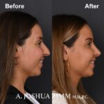 Rhinoplasty - before and after