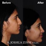 Rhinoplasty - before and after