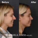 Rhinoplasty - before and after