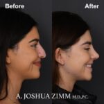 Rhinoplasty - before and after