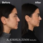 Rhinoplasty - before and after