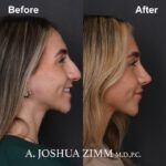 Rhinoplasty - before and after