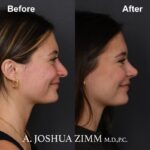 Rhinoplasty - before and after