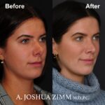 Rhinoplasty - before and after