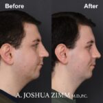 Rhinoplasty - before and after