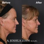 Rhinoplasty - before and after