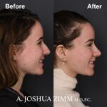 Rhinoplasty - before and after