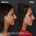 Rhinoplasty - before and after