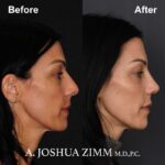 Rhinoplasty - before and after