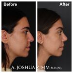 Rhinoplasty - before and after