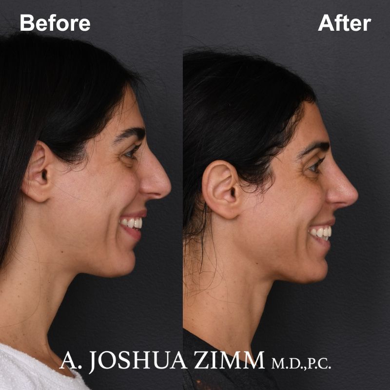 Rhinoplasty - before and after