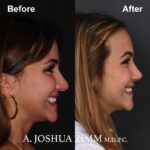 Rhinoplasty - before and after