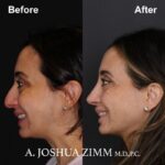 Rhinoplasty - before and after