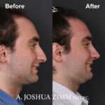 Rhinoplasty - before and after