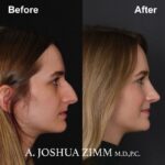 Rhinoplasty - before and after