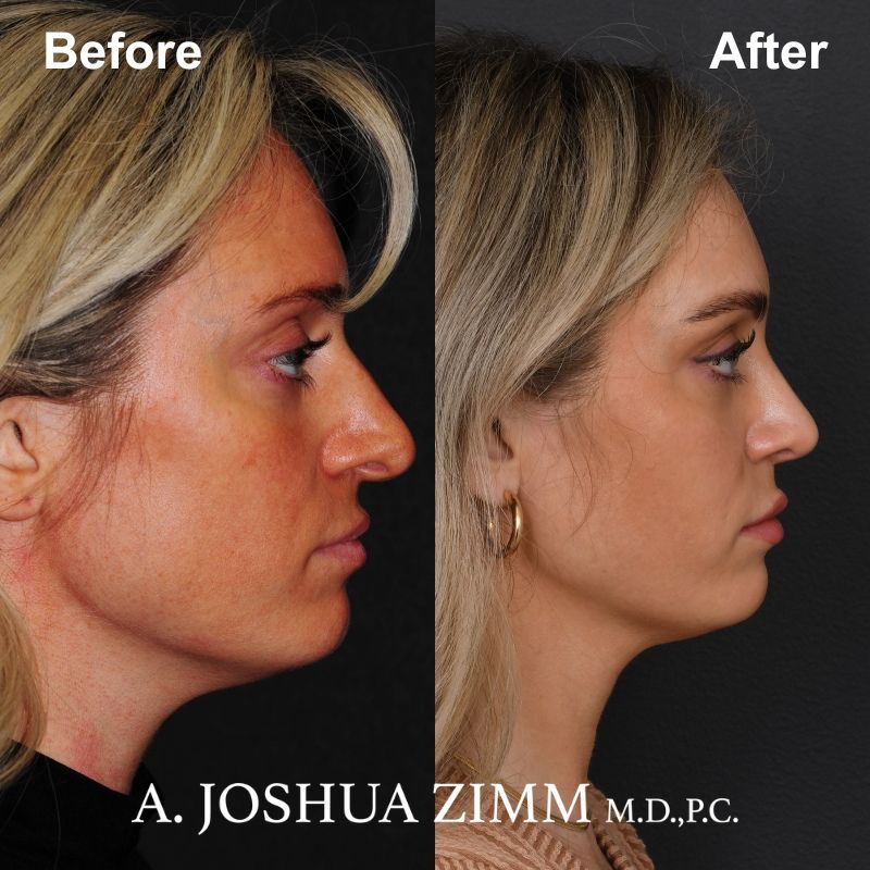 Rhinoplasty - before and after